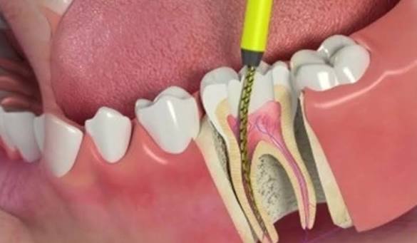 Painless Root Canal & Dental Surgery OT